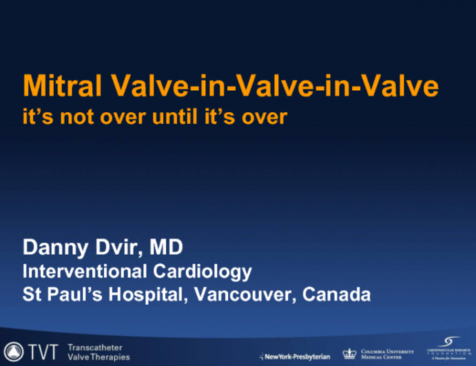 Mitral Valve-in-Valve-in-Valve