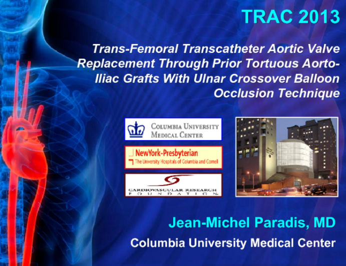 Trans-Femoral Transcatheter Aortic Valve Replacement Through Prior Tortuous Aorto-Iliac Grafts With Ulnar Crossover Balloon Occlusion Technique