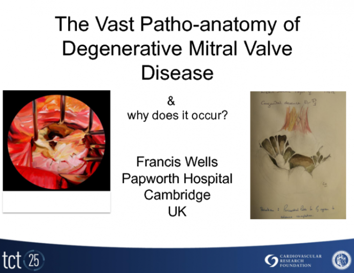 The Vast Pathoanatomy of Degenerative MR