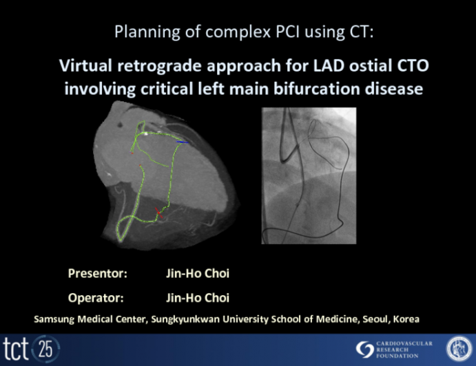 PCI of an Invisible RCA Ostial CTO Assisted By CT