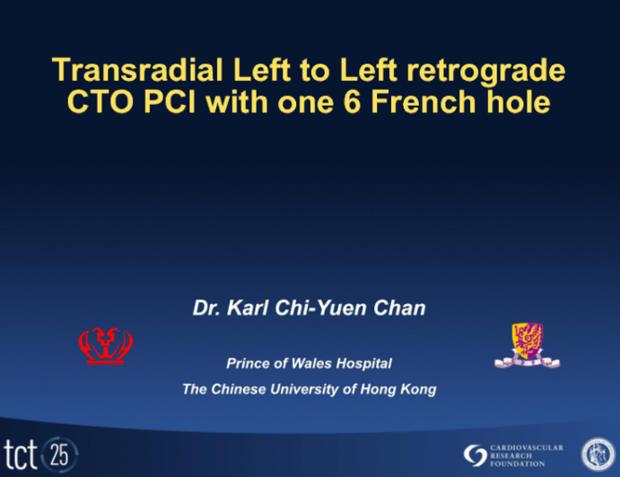 Transradial Left To Left Retrograde CTO PCI with a Single 6 French Access