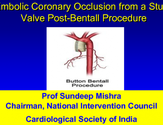 Case #3: Embolic Coronary Occlusion from a Stuck Valve Post-Bental Procedure