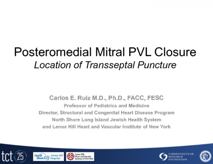 For Posteromedial Mitral Paravalvular Leak Closure