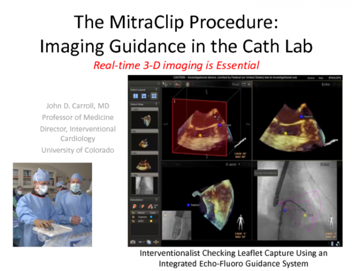 The MitraClip Procedure: Imaging Guidance in the Cath Lab