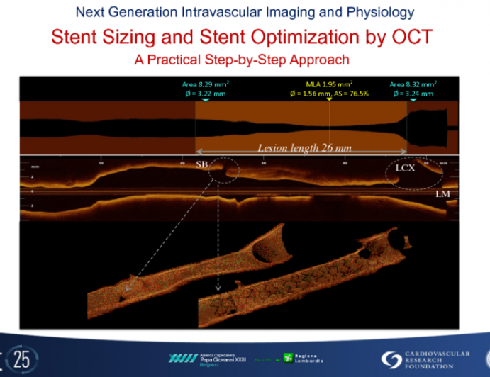 Stent Sizing and Stent Optimization by OCT: A Practical Step-by-Step Approach and Emerging Data About Endpoints and Efficacy