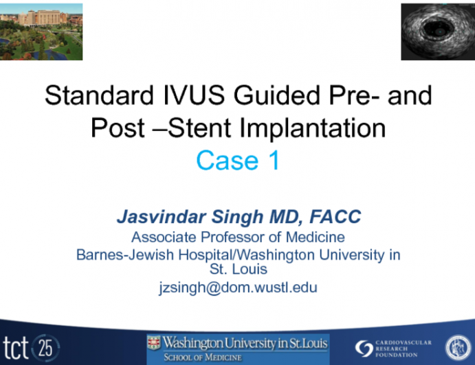 Case I: Standard IVUS Guided Pre- and Post-Stent Implantation