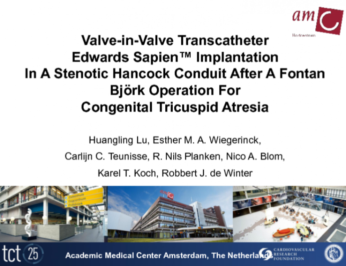 A Collaboration in Adult Congenital Cardiac Care; Valve-in-Valve Transcatheter Edwards Sapien™ Implantation In A Degenerated Stenotic Hancock Conduit After A Fontan Björk...