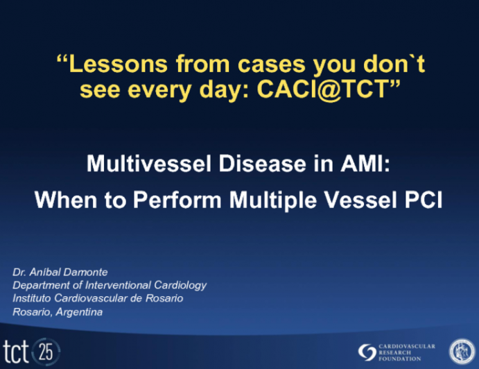 Multivessel Disease in AMI: When to Perform Multiple Vessel PCI