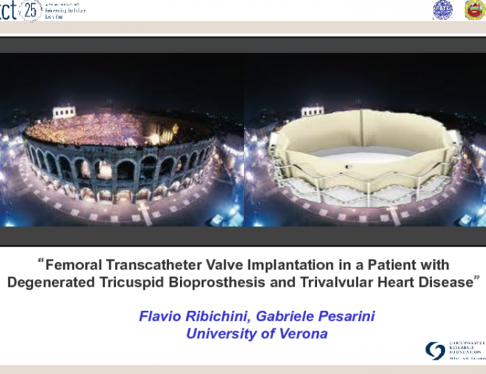 First Prize: Case Presentation: Transcatheter Valve Implantation in a Patient with Degenerated Tricuspid Bioprosthesis and Trivalvular Heart Disease