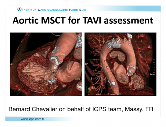 Aortic MSCT for TAVI Assessment