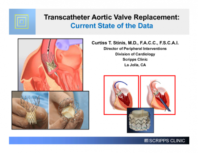 Transcatheter Aortic Valve Replacement: Current State of the Data