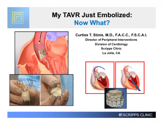 My TAVR Just Embolized: Now What?