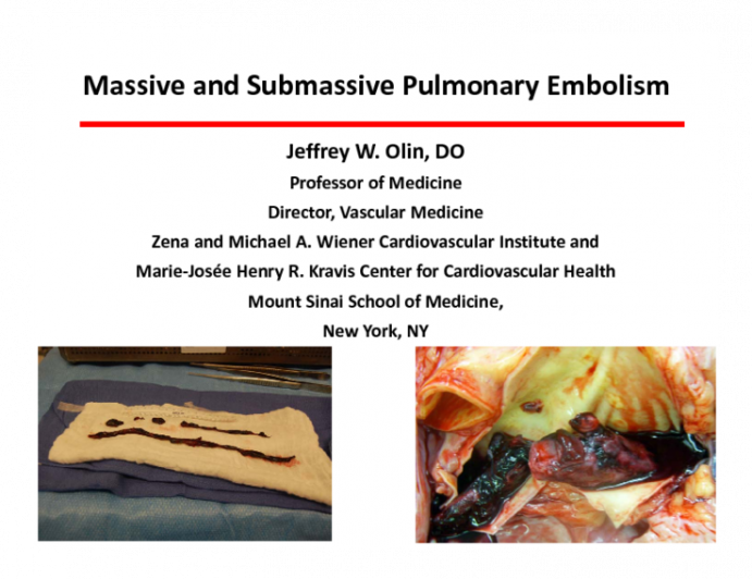 Massive and Submassive PE: What Is the Difference and What Does the Data on Intervention Show?