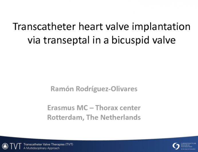 Transcatheter Heart Valve Implantation via Transeptal in a Bicuspid Valve