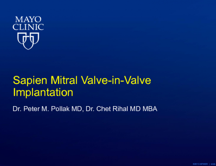 Sapien Mitral Valve-in-Valve Implantation