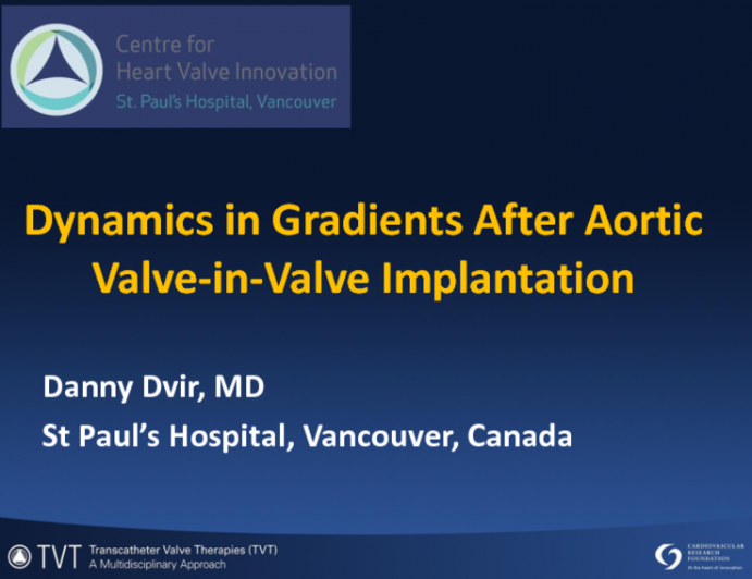 Dynamics in Gradients after Aortic Valve-in-Valve Implantation: An Argument for Anticoagulation Treatment