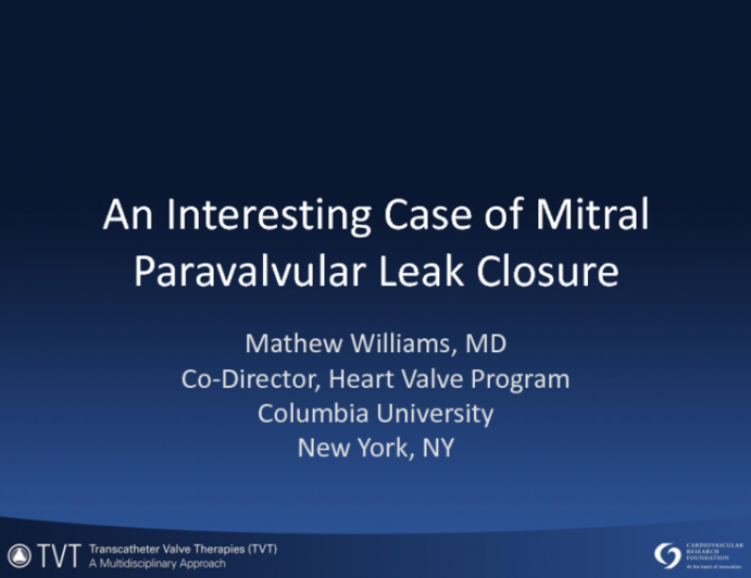 An Interesting Case of Mitral Paravalvular Leak Closure