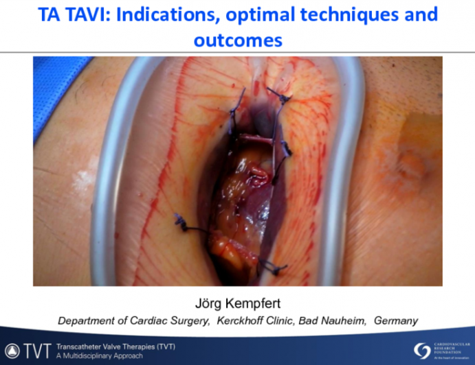 Transapical TAVR: Indications, Optimal Technique, and Outcomes