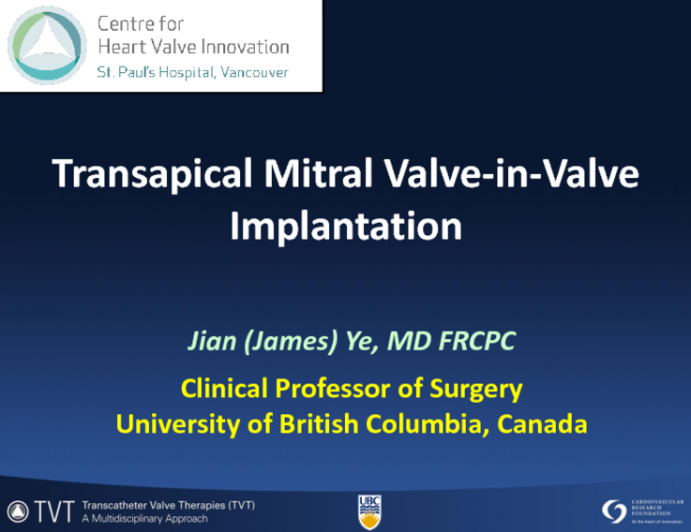 Transapical Mitral Valve-in-Valve