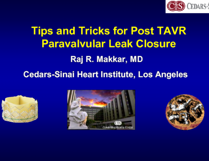 Paravalvular Leak Closure after TAVR: Indications and Technical Insights