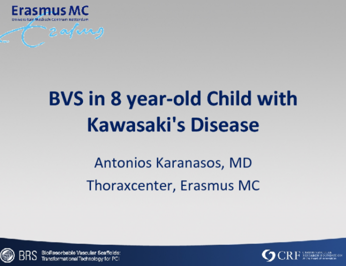 BVS in 8 year-old Child with Kawasaki's Disease