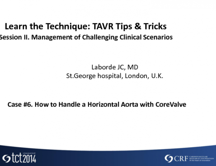 Case #6. How to Handle a Horizontal Aorta with CoreValve