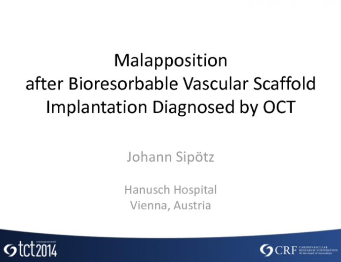 Case #2: Malapposition After Bioresorbable Vascular Scaffold Implantation Diagnosed by IVUS/OCT