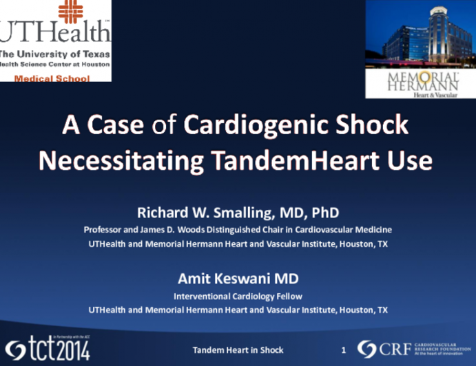 A Case of Cardiogenic Shock Necessitating TandemHeart Use