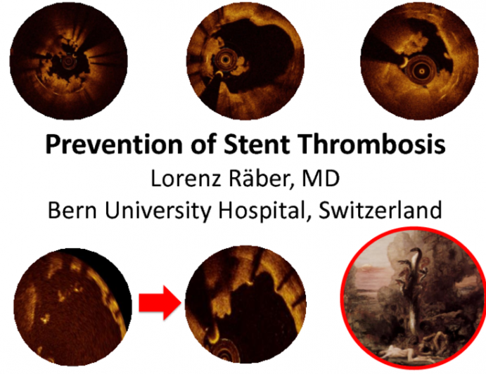 Prevention of Stent Thrombosis: Devices, Pharmacology, Technique, Patients, and More