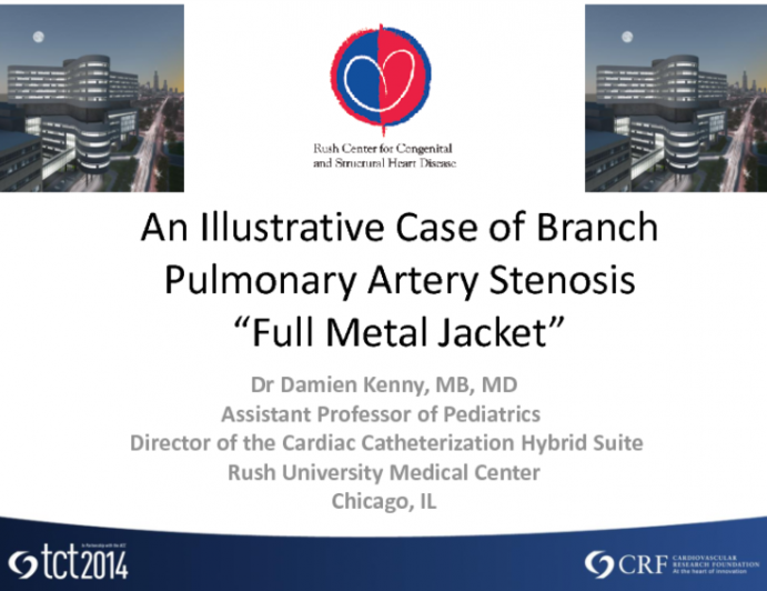 An Illustrative Case of Branch Pulmonary Artery Stenosis