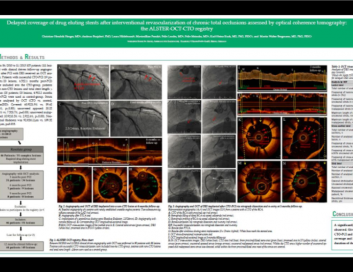 Delayed coverage of drug eluting stents after interventional revascularization of chronic total occlusions assessed by optical coherence tomography: the ALSTER-OCT-CTO registry