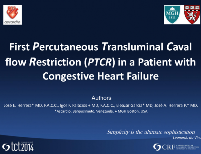 First Percutaneous Transluminal Caval flow Restriction in a Patient with Congestive Heart Failure_