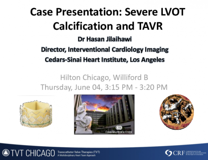 Case Presentation: Severe LVOT Calcification and TAVR