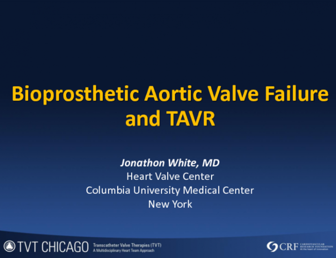 Case Presentation: Bioprosthetic Aortic Valve Failure and TAVR