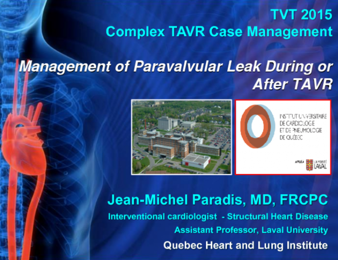 Case Presentation: Management of Paravalvular Leaks During or After TAVR