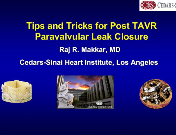 Step by Step: Aortic Paravalvular Leak Closure