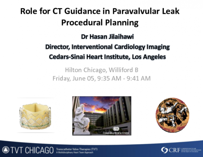 Role for CT Guidance in Paravalvular Leak Procedural Planning