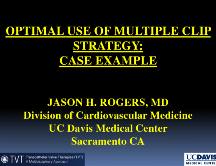 Case 3: Optimal Use of Multiple Clip Strategy