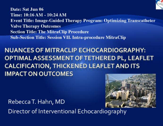 Nuances of MitraClip Echocardiography: Optimal Assessment of Tethered PL, Leaflet Calcification, Thickened Leaflet and Its Impact on Outcomes