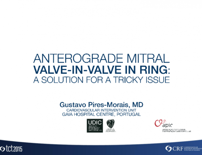 CASE 3: Anterograde Mitral Valve-in-Valve-in-Ring: The Solution for a Tricky Issue