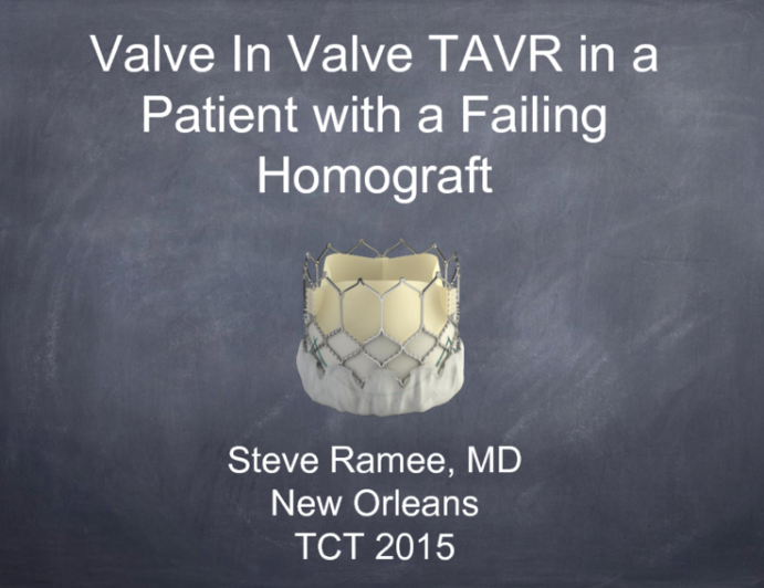 Bioprosthetic Aortic Valve Failure and TAVR: Case Presentation