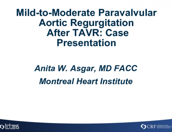 Mild-to-Moderate Paravalvular Aortic Regurgitation After TAVR: Case Presentation