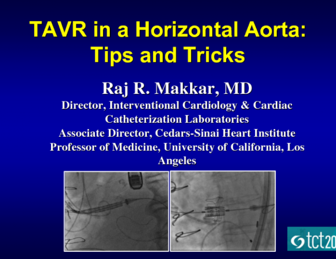 TAVR in a Horizontal Aorta: Tips and Tricks (With a Case)