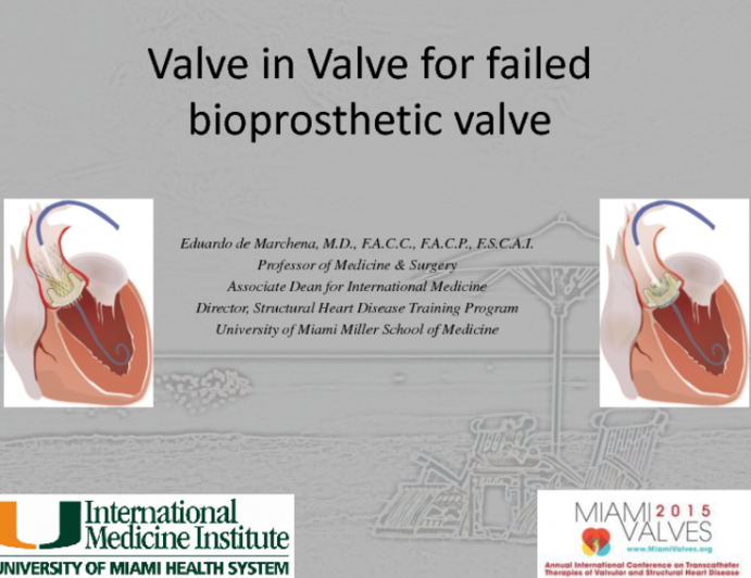 Valve in Valve for Failed Bioprosthetic Valve