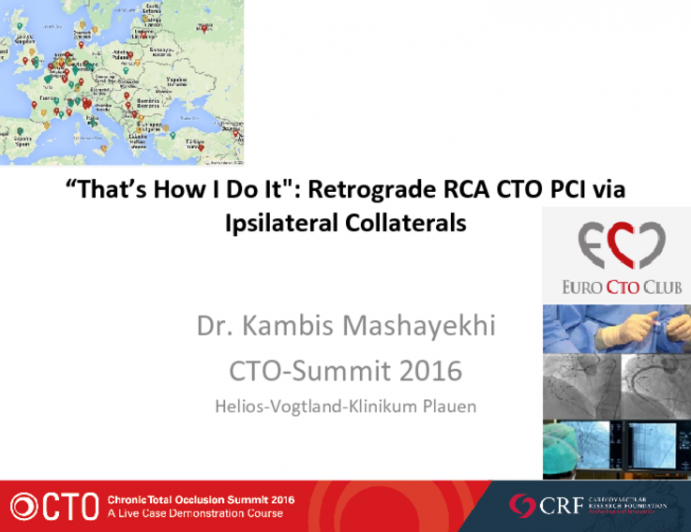 That’s How I Do It: Retrograde RCA CTO PCI via Ipsilateral Collateral