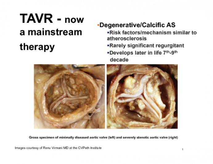 TAVR - now a mainstream therapy