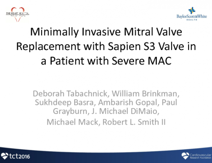 TCT 1600: Minimally Invasive Mitral Valve Replacement With Sapien S3 Valve in a Patient With Severe MAC