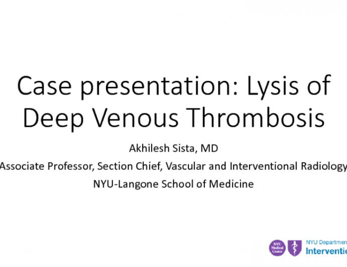 Lysis of Deep Venous Thrombosis