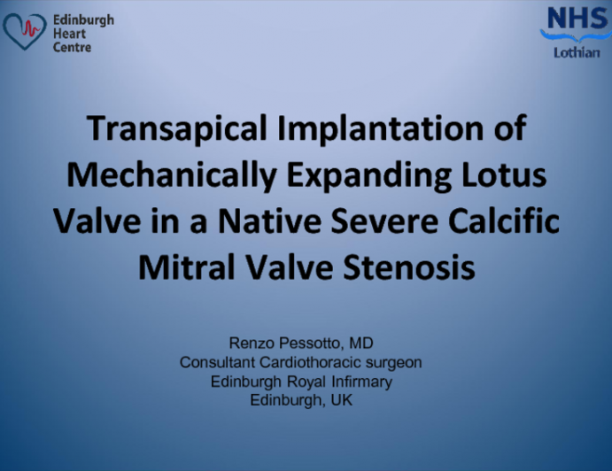 TVT 1035: Transapical Implantation of Mechanically Expanding Lotus Valve in a Native Severe Calcific Mitral Valve Stenosis
