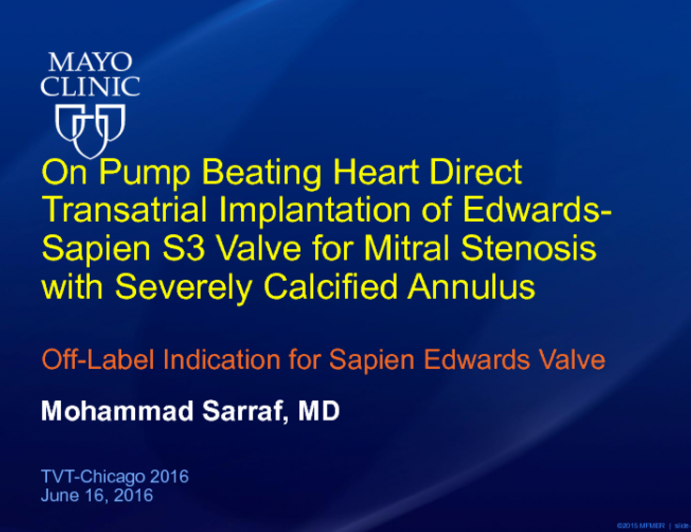 TVT 1126: On-Pump Beating-Heart Direct Transatrial Implantation of Edwards Sapien 3 Valve for Mitral Stenosis With Severely Calcified Annulus